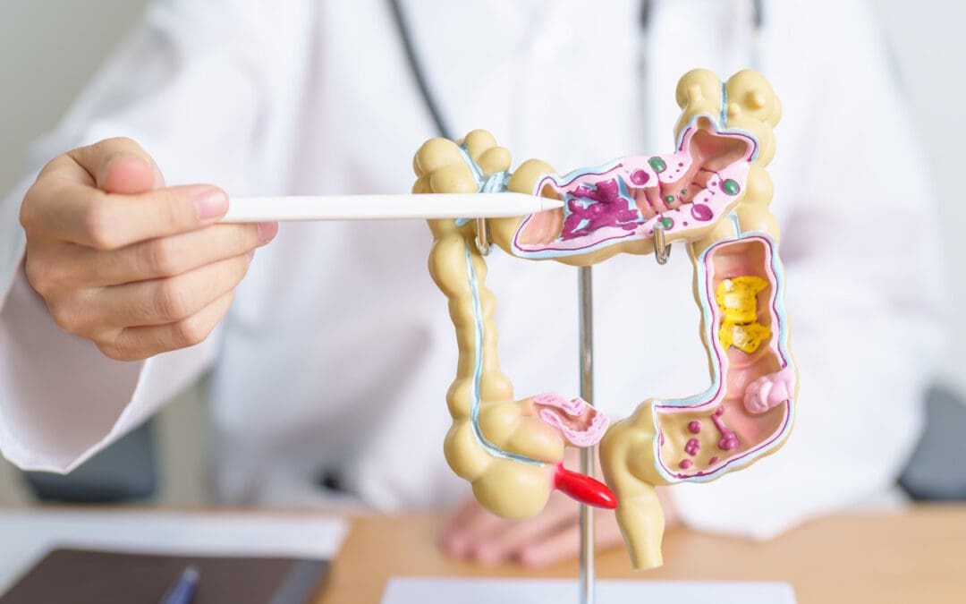 Intestinal Ischemic Syndrome